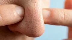 Tämä ongelma huolestuttaa monia, mutta kaikki eivät tiedä, miten helposti sen voi ratkaista.