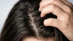 Miten päästä eroon rasvoittuvista hiuksista itse kotona